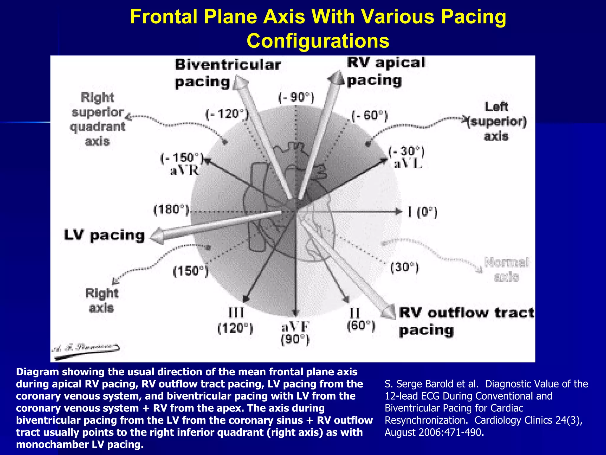 Frontal Plane Axis With Various Pacing Configurations Diagram showing the usual direction of the mean frontal plane axis during apical RV pacing, RV outflow tract pacing, LV pacing from the coronary venous system, and biventricular pacing with LV from the coronary venous system + RV from the apex. The axis during biventricular pacing from the LV from the coronary sinus + RV outflow tract usually points to the right inferior quadrant (right axis) as with monochamber LV pacing. S. Serge Barold et al.  Diagnostic Value of the 12-lead ECG During Conventional and Biventricular Pacing for Cardiac Resynchronization.  Cardiology Clinics 24(3), August 2006:471-490. 