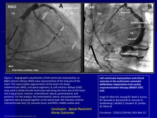 © 2011 American Heart Association, Inc. Left ventricular lead position and clinical outcome in the multicenter automatic defibrillator implantation trial-cardiac resynchronization therapy (MADIT-CRT) trial. Singh JP; Klein HU; Huang DT; Reek S; Kuniss M; Quesada A; Barsheshet A; Cannom D; Goldenberg I; McNitt S; Daubert JP; Zareba W; Moss AJ Circulation.  123(11):1159-66, 2011 Mar 22. Figure 1 . Angiographic classification of left ventricular lead position. A, Right anterior oblique (RAO) view representative of the long axis of the heart. This view enables segmentation of the heart into basal, midventricular (MID), and apical segments. B, Left anterior oblique (LAO) view used to divide the left ventricular wall along the short axis of the heart into 5 equal parts; anterior, anterolateral, lateral, posterolateral, and posterior. For the analysis, the anterolateral, lateral, and posterolateral segments were grouped together as the lateral wall. AIV indicates anterior interventricular vein; CS, coronary sinus; and MCV, middle cardiac vein. Conclusion:  Apical Placement Worse Outcomes 