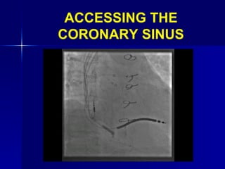 ACCESSING THE CORONARY SINUS 