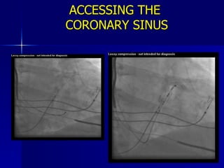 ACCESSING THE  CORONARY SINUS 