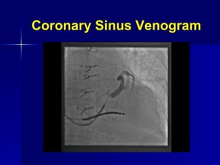 Coronary Sinus Venogram 