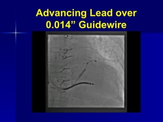 Advancing Lead over 0.014” Guidewire 