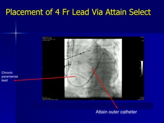 Placement of 4 Fr Lead Via Attain Select Attain outer catheter Chronic pace/sense lead 