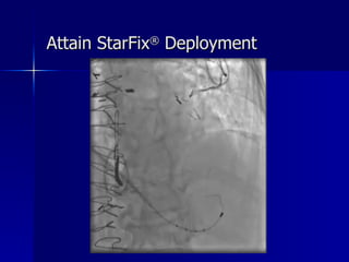 Attain StarFix ®  Deployment 