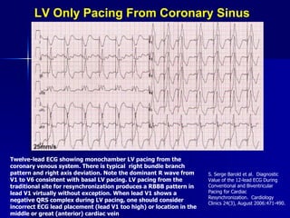LV Only Pacing From Coronary Sinus Twelve-lead ECG showing monochamber LV pacing from the coronary venous system. There is typical  right bundle branch pattern and right axis deviation. Note the dominant R wave from V1 to V6 consistent with basal LV pacing. LV pacing from the traditional site for resynchronization produces a RBBB pattern in lead V1 virtually without exception. When lead V1 shows a negative QRS complex during LV pacing, one should consider incorrect ECG lead placement (lead V1 too high) or location in the middle or great (anterior) cardiac vein S. Serge Barold et al.  Diagnostic Value of the 12-lead ECG During Conventional and Biventricular Pacing for Cardiac Resynchronization.  Cardiology Clinics 24(3), August 2006:471-490. 