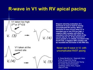 R-wave in V1 with RV apical pacing Diagram showing evaluation of a dominant R wave in lead V1 during uncomplicated RV pacing. When a dominant R wave occurs when V1 is recorded one or two ICS too high, a negative QRS complex will often be recorded in the fourth ICS which is the correct site for V1. If the dominant R wave persists or is initially recorded in the fourth ICS, a negative QRS complex will be recorded one ICS lower in the fifth ICS.   Never see R-wave in V1 with uncomplicated RVOT pacing S. Serge Barold et al.  Diagnostic Value of the 12-lead ECG During Conventional and Biventricular Pacing for Cardiac Resynchronization.  Cardiology Clinics 24(3), August 2006:471-490. 