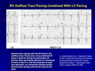 RV Outflow Tract Pacing Combined With LV Pacing Biventricular pacing with the RV lead in the outflow tract. There was a very prominent R wave in lead V1 during monochamber LV pacing. Note the typical absence of a dominant R wave in lead V1, and the presence of right axis deviation, an uncommon finding during biventricular pacing with the RV lead at the apex.   S. Serge Barold et al.  Diagnostic Value of the 12-lead ECG During Conventional and Biventricular Pacing for Cardiac Resynchronization.  Cardiology Clinics 24(3), August 2006:471-490. 