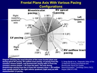 Frontal Plane Axis With Various Pacing Configurations Diagram showing the usual direction of the mean frontal plane axis during apical RV pacing, RV outflow tract pacing, LV pacing from the coronary venous system, and biventricular pacing with LV from the coronary venous system + RV from the apex. The axis during biventricular pacing from the LV from the coronary sinus + RV outflow tract usually points to the right inferior quadrant (right axis) as with monochamber LV pacing. S. Serge Barold et al.  Diagnostic Value of the 12-lead ECG During Conventional and Biventricular Pacing for Cardiac Resynchronization.  Cardiology Clinics 24(3), August 2006:471-490. 