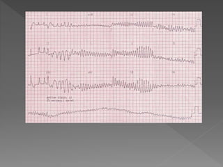 Cardiac rhythm disorders
