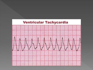 Cardiac rhythm disorders