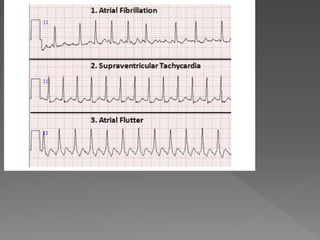 Cardiac rhythm disorders