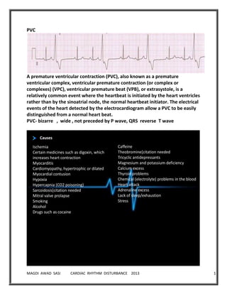 MAGDI AWAD SASI CARDIAC RHYTHM DISTURBANCE 2013 19
PVC
A premature ventricular contraction (PVC), also known as a premature
ventricular complex, ventricular premature contraction (or complex or
complexes) (VPC), ventricular premature beat (VPB), or extrasystole, is a
relatively common event where the heartbeat is initiated by the heart ventricles
rather than by the sinoatrial node, the normal heartbeat initiator. The electrical
events of the heart detected by the electrocardiogram allow a PVC to be easily
distinguished from a normal heart beat.
PVC- bizarre , wide , not preceded by P wave, QRS reverse T wave
Causes
Ischemia
Certain medicines such as digoxin, which
increases heart contraction
Myocarditis
Cardiomyopathy, hypertrophic or dilated
Myocardial contusion
Hypoxia
Hypercapnia (CO2 poisoning)
Sarcoidosis[citation needed
Mitral valve prolapse
Smoking
Alcohol
Drugs such as cocaine
Caffeine
Theobromine[citation needed
Tricyclic antidepressants
Magnesium and potassium deficiency
Calcium excess
Thyroid problems
Chemical (electrolyte) problems in the blood
Heart attack
Adrenaline excess
Lack of sleep/exhaustion
Stress
 