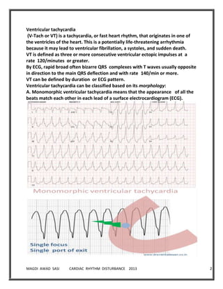 MAGDI AWAD SASI CARDIAC RHYTHM DISTURBANCE 2013 22
Ventricular tachycardia
(V-Tach or VT) is a tachycardia, or fast heart rhythm, that originates in one of
the ventricles of the heart. This is a potentially life-threatening arrhythmia
because it may lead to ventricular fibrillation, a systoles, and sudden death.
VT is defined as three or more consecutive ventricular ectopic impulses at a
rate 120/minutes or greater.
By ECG, rapid broad often bizarre QRS complexes with T waves usually opposite
in direction to the main QRS deflection and with rate /min or more.
VT can be defined by duration or ECG pattern.
Ventricular tachycardia can be classified based on its morphology:
A. Monomorphic ventricular tachycardia means that the appearance of all the
beats match each other in each lead of a surface electrocardiogram (ECG).
 