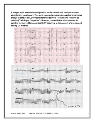 MAGDI AWAD SASI CARDIAC RHYTHM DISTURBANCE 2013 23
B. Polymorphic ventricular tachycardia, on the other hand, has beat-to-beat
variations in morphology. This most commonly appears as a cyclical progressive
change in cardiac axis, previously referred to by its French name torsades de
pointes ("twisting of the points"). However, currently the term torsades de
pointes is reserved for polymorphic VT occurring in the context of a prolonged
resting QT interval.
 