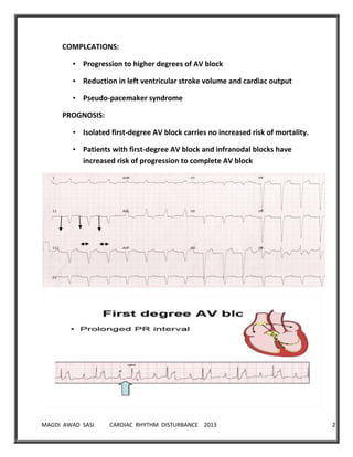 MAGDI AWAD SASI CARDIAC RHYTHM DISTURBANCE 2013 29
COMPLCATIONS:
• Progression to higher degrees of AV block
• Reduction in left ventricular stroke volume and cardiac output
• Pseudo-pacemaker syndrome
PROGNOSIS:
• Isolated first-degree AV block carries no increased risk of mortality.
• Patients with first-degree AV block and infranodal blocks have
increased risk of progression to complete AV block
 