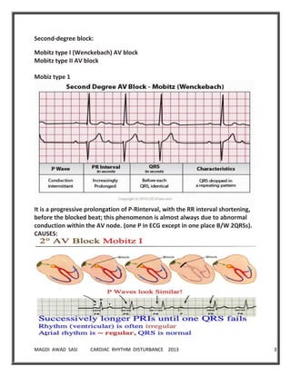MAGDI AWAD SASI CARDIAC RHYTHM DISTURBANCE 2013 30
Second-degree block:
Mobitz type I (Wenckebach) AV block
Mobitz type II AV block
Mobiz type 1
It is a progressive prolongation of P-Rinterval, with the RR interval shortening,
before the blocked beat; this phenomenon is almost always due to abnormal
conduction within the AV node. (one P in ECG except in one place B/W 2QRSs).
CAUSES:
 