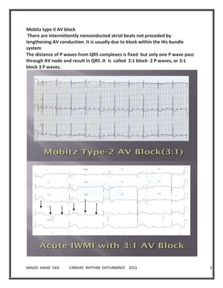 MAGDI AWAD SASI CARDIAC RHYTHM DISTURBANCE 2013 32
Mobitz type II AV block
There are intermittently nonconducted atrial beats not preceded by
lengthening AV conduction. It is usually due to block within the His bundle
system.
The distance of P waves from QRS complexes is fixed but only one P wave pass
through AV node and result in QRS .It is called 2:1 block- 2 P waves, or 3:1
block 3 P waves.
 