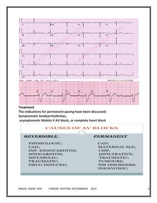 MAGDI AWAD SASI CARDIAC RHYTHM DISTURBANCE 2013 35
Treatment
The indications for permanent pacing have been discussed:
Symptomatic bradyarrhythmias,
asymptomatic Mobitz II AV block, or complete heart block
CAUSES OF AV BLOCKS
REVERSIBLE PERMANENT
PHYSIOLOGIC; CAD;
CAD; MATERNAL SLE;
INF. ENDOCARDITIS; CMP;
MYOCARDITIS; INFILTRATIVE;
METABOLIC; TRAUMATIC;
TRAUMATIC; TUMOURS;
DRUG INDUCED; NM DISORDERS;
IDIOPATHIC;
 