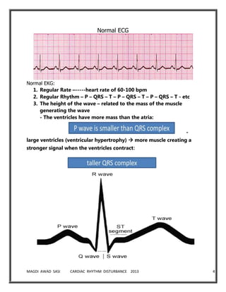 MAGDI AWAD SASI CARDIAC RHYTHM DISTURBANCE 2013 4
Normal ECG
Normal EKG:
1. Regular Rate –-----heart rate of 60-100 bpm
2. Regular Rhythm – P – QRS – T – P – QRS – T – P – QRS – T - etc
3. The height of the wave – related to the mass of the muscle
generating the wave
- The ventricles have more mass than the atria:
-
large ventricles (ventricular hypertrophy)  more muscle creating a
stronger signal when the ventricles contract:
 