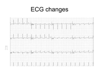 ECG changes
 