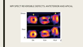 Mpi Defect Stringer Cardiac Stress Testing Seminar | PPTX