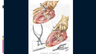 Cardiac surgery | PPT