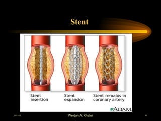 Stent  