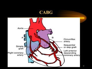 CABG 
