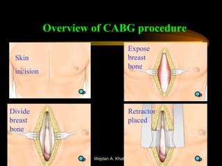 Overview of CABG procedure Skin  incision Expose breast bone Divide breast bone Retractor placed 