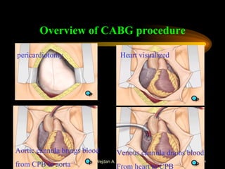 Overview of CABG procedure pericardiotomy Heart visualized Aortic cannula brings blood  from CPB to aorta Venous cannula drains blood From heart to CPB 
