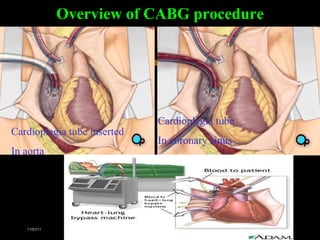 Overview of CABG procedure Cardioplegia tube inserted In aorta Cardioplegia tube In coronary sinus 