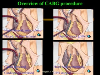 Overview of CABG procedure Heart stopped, aortic clamp Placed, no flow in heart Bypass vessel grafted Clamp removed,  Cardioplegia reversed Heart beating normally, CPB stopped 