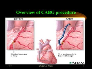Overview of CABG procedure 