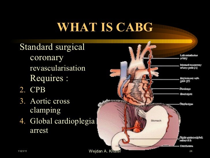 Cardiac surgery and ptca