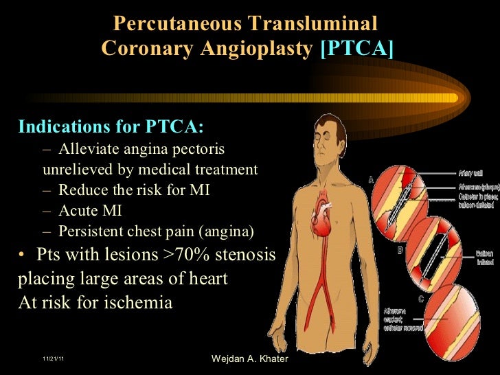 percutaneous transluminal coronary angioplasty essay Percutaneous transluminal angioplasty and unitedhealthcare® medicare advantage policy guideline percutaneous coronary interventions page 2 of 5. percutaneous transluminal coronary angioplasty essay Percutaneous transluminal angioplasty and unitedhealthcare® medicare advantage policy guideline percutaneous coronary interventions page 2 of 5.