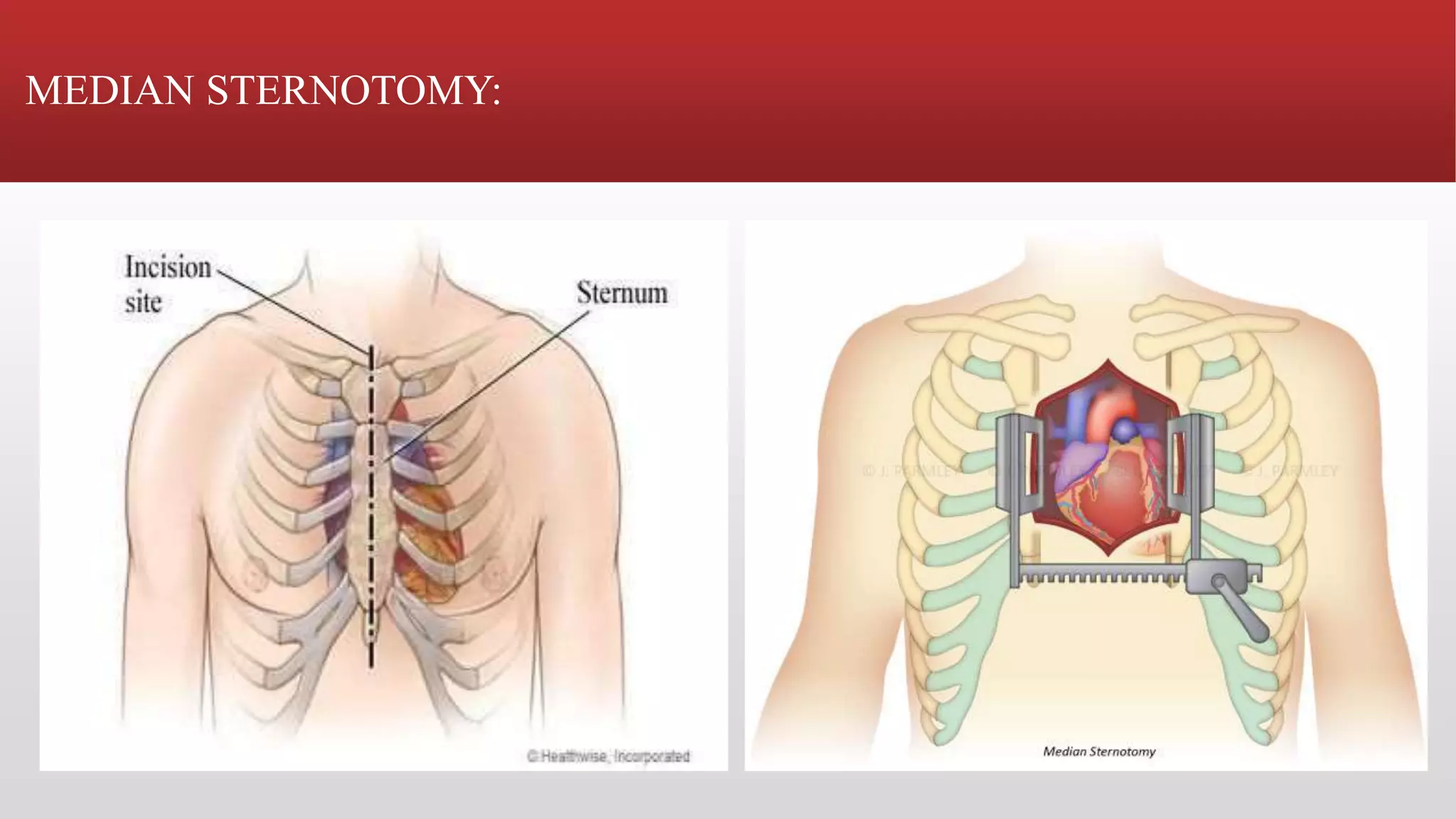 Steriotomy Cardiac surgery | PPTX
