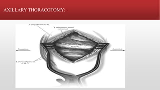 Cardiac surgery | PPTX