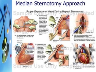 Strnotomy Cardiac surgical procedures | PDF