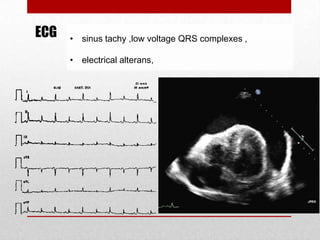 ECG   • sinus tachy ,low voltage QRS complexes ,

      • electrical alterans,
 