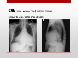 CXR:    large, globular heart, enlarge cardiac

silhouette, water bottle shaped heart
 