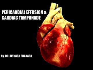 PERICARDIAL EFFUSION &
CARDIAC TAMPONADE




by DR. AVINASH PRAKASH
 