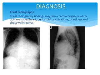 DIAGNOSIS 
 Chest radiography 
 Chest radiography findings may show cardiomegaly, a water 
bottle–shaped heart, pericardial calcifications, or evidence of 
chest wall trauma. 
 
