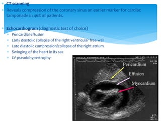  CT scanning 
 Reveals compression of the coronary sinus an earlier marker for cardiac 
tamponade in 46% of patients. 
 Echocardiogram (diagnostic test of choice) 
 Pericardial effusion 
 Early diastolic collapse of the right ventricular free wall 
 Late diastolic compression/collapse of the right atrium 
 Swinging of the heart in its sac 
 LV pseudohypertrophy 
 