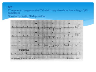  ECG 
 ST segment changes on the ECG which may also show low voltage QRS 
complexes 
 Sinus tachycardia, PR depression, 
 