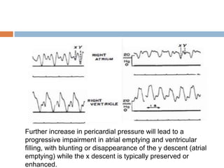 Further increase in pericardial pressure will lead to a
progressive impairment in atrial emptying and ventricular
filling, with blunting or disappearance of the y descent (atrial
emptying) while the x descent is typically preserved or
enhanced.
 