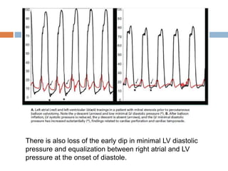 There is also loss of the early dip in minimal LV diastolic
pressure and equalization between right atrial and LV
pressure at the onset of diastole.
 