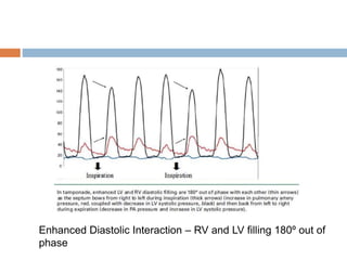 Enhanced Diastolic Interaction – RV and LV filling 180º out of
phase
 