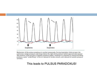 This leads to PULSUS PARADOXUS!
 