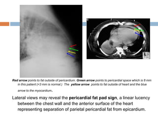 Red arrow points to fat outside of pericardium. Green arrow points to pericardial space which is 8 mm
in this patient (<3 mm is normal.) The yellow arrow points to fat outside of heart and the blue
arrow to the myocardium.
Lateral views may reveal the pericardial fat pad sign, a linear lucency
between the chest wall and the anterior surface of the heart
representing separation of parietal pericardial fat from epicardium.
 