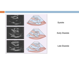 Systole
Early Diastole
Late Diastole
 